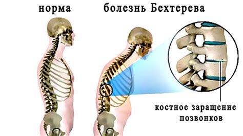 болезнь бехтерева сколько живут